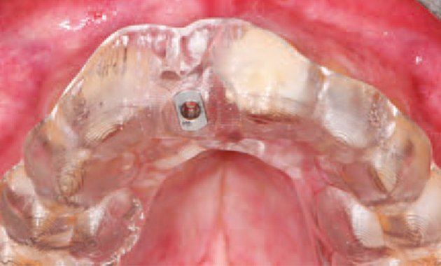 Implant pour l’avenir Implant pour l’avenir