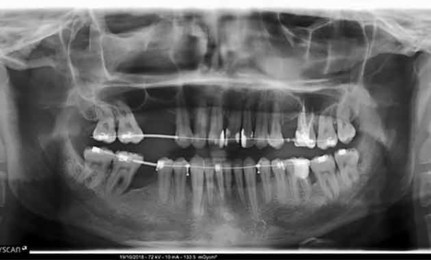 Traitement orthodontique du patient adulte avec parodonte affaibli Traitement orthodontique du patient adulte avec parodonte affaibli