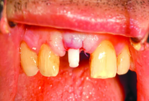 implant monobloc zircone