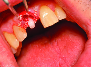 implant monobloc zircone