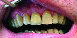 implant monobloc zircone