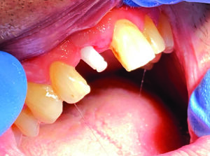 implant monobloc zircone