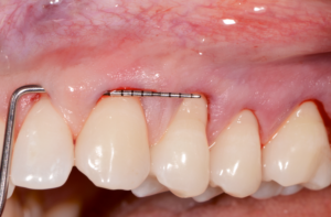 Incisions intrasulculaires