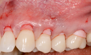 récessions gingivales