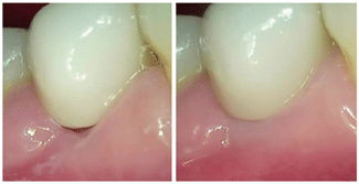 modifications de la ligne gingivale mésiale