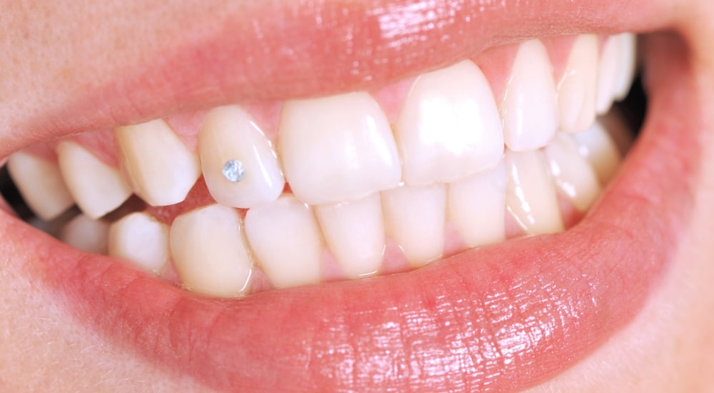strass dentaire tiktok