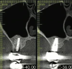 CBCT à deux ans