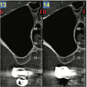 CBCT préopératoire