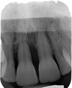 Évaluation radiographique de la lésion.