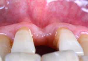 Défaut mucco-gingival