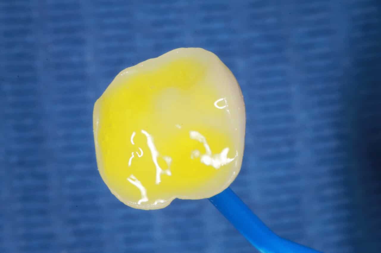Fig.14 : Pose, traitement de la surface céramique par acide fluorhydrique à 9 %.