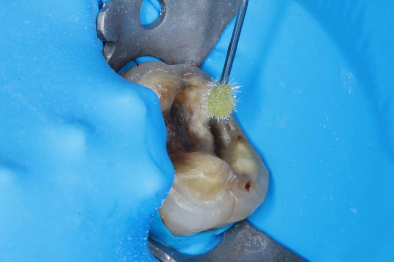 Fig.10 et 11 : Massage dentinaire et amélaire par adhésif mis en excès pour obtenir une augmentation de la mouillabilité des surfaces avant ablation des excès par aspiration et soufflage.