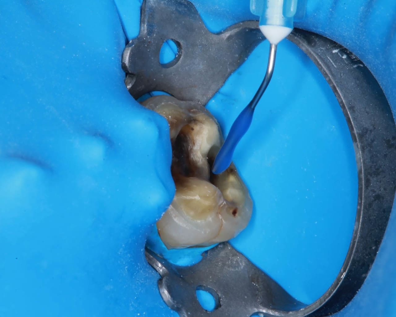 Fig.8 et 9 : Utilisation d'un acide orthophosphorique à 36 % sur la surface amélaire et dentinaire.
