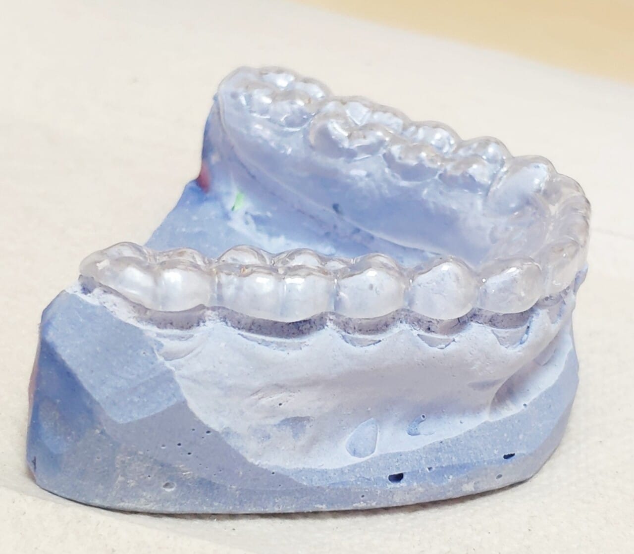 La gouttière occlusale doit être réalisée en résine dure, recouvrir l’ensemble des dents de l’arcade (maxillaire ou mandibulaire dans ce cas) et avoir une épaisseur comprise entre 1,5 et 2 mm.