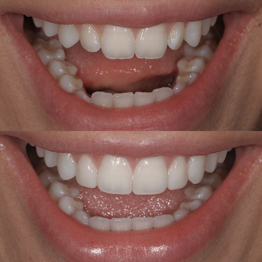 Fig.2 : Cas clinique avant-après, restaurations en composite, vue frontale en occlusion (Dr F. Grossetti).