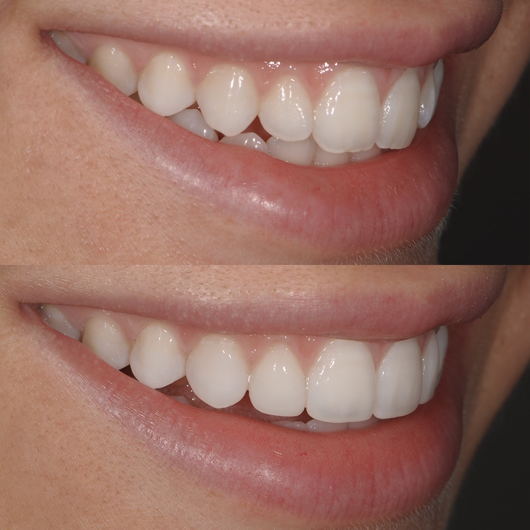 Fig.3 : Cas clinique avant-après, restaurations en composite, vue frontale en désocclusion (Dr F. Grossetti).